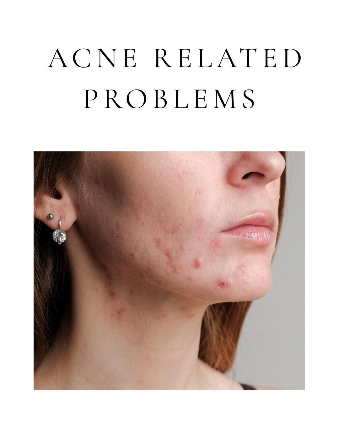 Acne